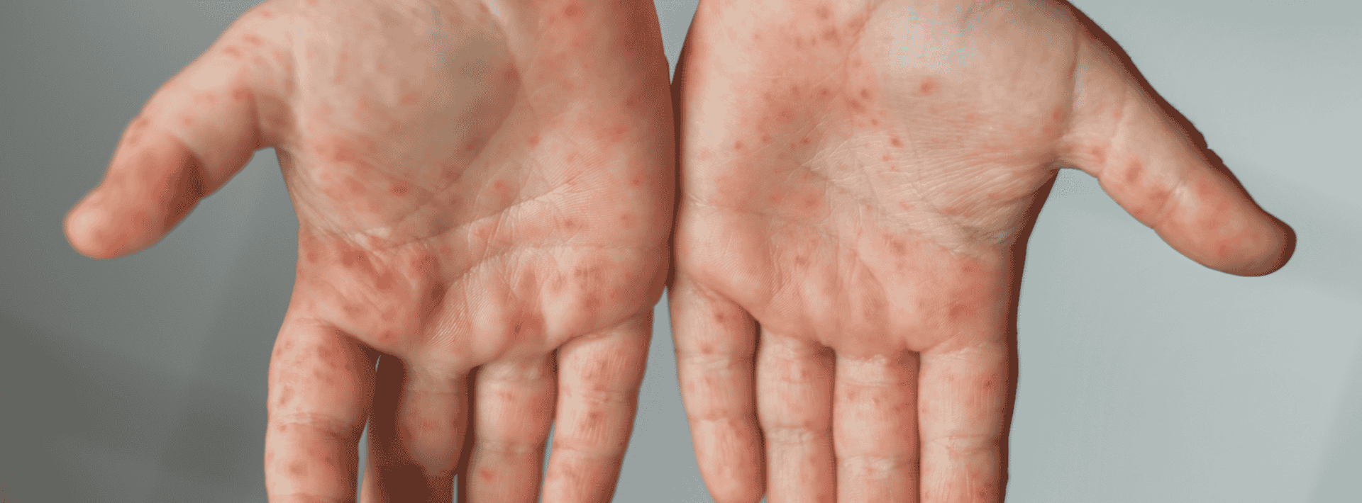 ลูกไข้สูงมีผื่นแดงต้องระวัง อาจเสี่ยง ‘โรคไข้อีดำอีแดง’