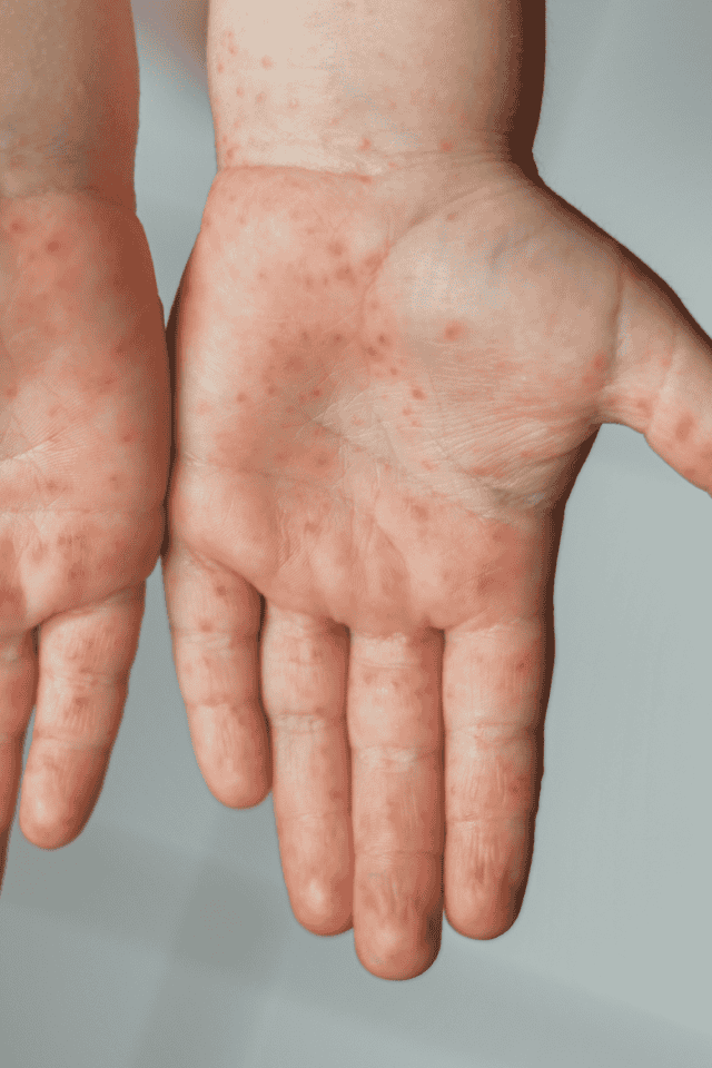 ลูกไข้สูงมีผื่นแดงต้องระวัง อาจเสี่ยง ‘โรคไข้อีดำอีแดง’