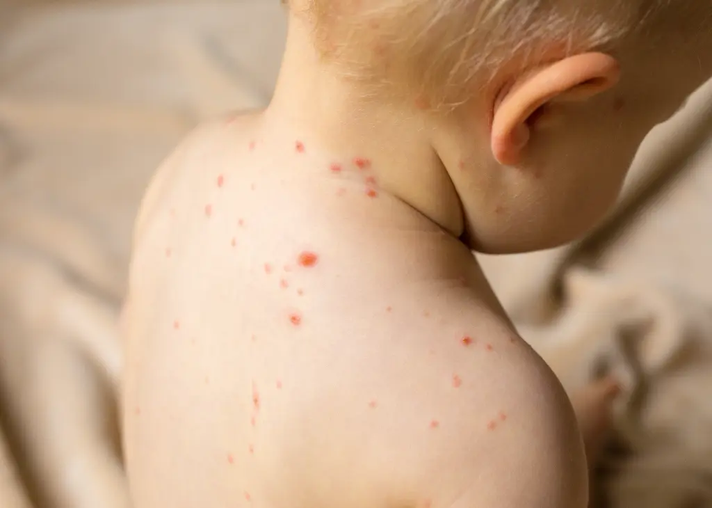 Winter Measles Risk: What Parents Should Know and Do