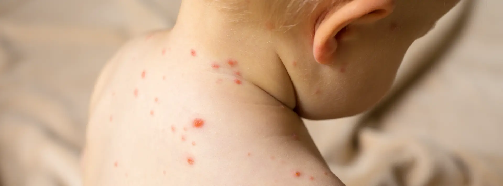 Winter Measles Risk: What Parents Should Know and Do
