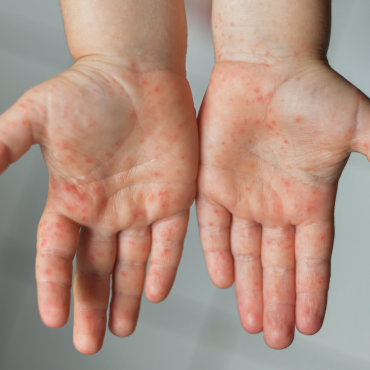 Children with high fever and red rashes should be watched carefully for risk of ‘scarlet fever’