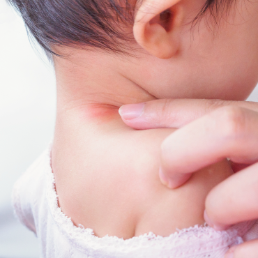 “Skin rash”: close danger that hurts baby's skin in hot and humid time