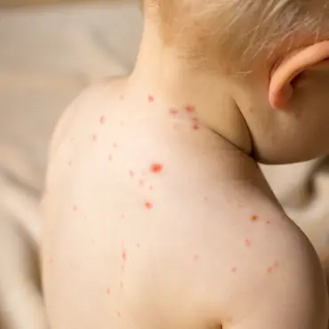 Winter Measles Risk: What Parents Should Know and Do