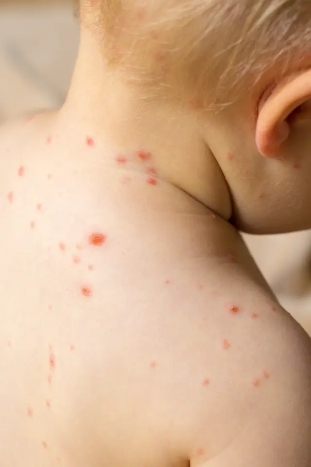 Winter Measles Risk: What Parents Should Know and Do